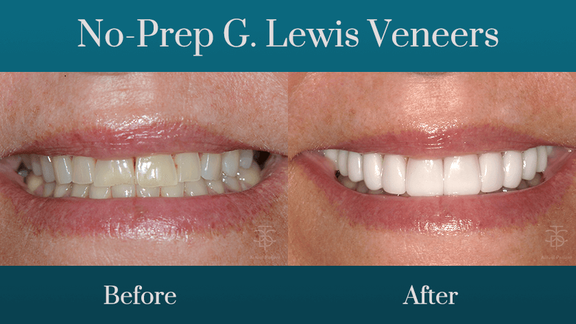 no-prep g. lewis veneers